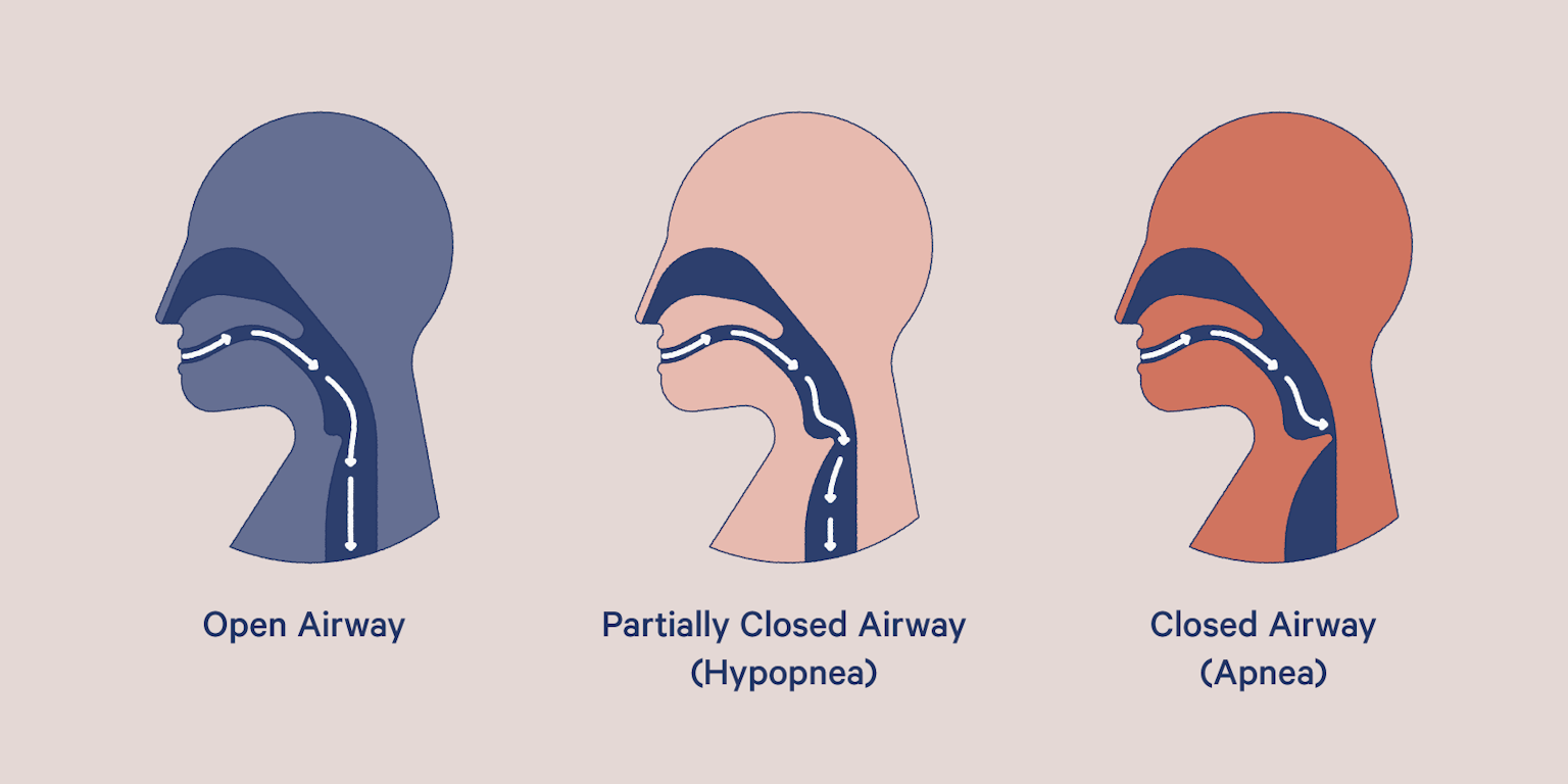 What Is Sleep Apnea? A Complete Guide | LaptrinhX / News